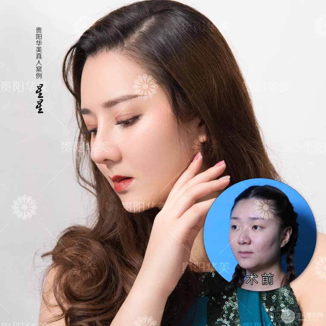 貴陽華美牛勇敢全切雙眼皮+假體隆鼻案例前后對比圖 華美員工全臉整形實錄