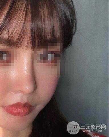 揚州艾菲斯整形隆鼻案例，自拍盛顏不是夢！