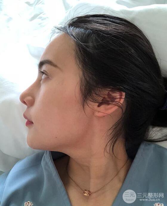 成都大華隆鼻怎么樣?真實(shí)案例前后對比圖記錄恢復(fù)過程