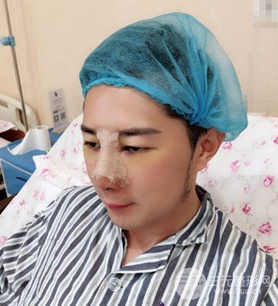 肋軟骨隆鼻整形案例分享，在深圳雅涵做的!