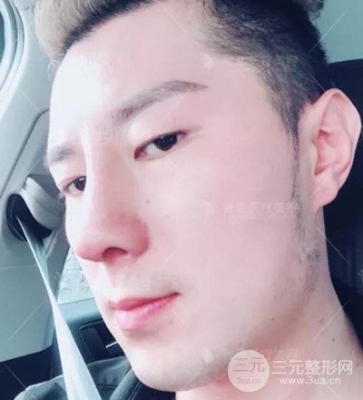 肋軟骨隆鼻整形案例分享，在深圳雅涵做的!