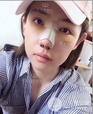 南京連天美整形周長兵隆鼻整形真人案例前后對比圖|內(nèi)附恢復(fù)過程心情日扎