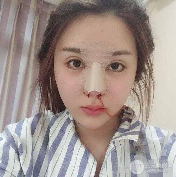 昆明吳氏嘉美李明硅膠隆鼻前后對比圖恢復(fù)心情小札