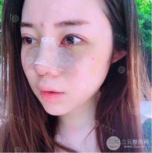 重慶華美何春濤假體隆鼻案例過程恢復(fù)分享