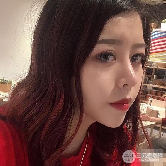 重慶華美何春濤硅膠隆鼻前后對比圖 內(nèi)附恢復(fù)心情小札