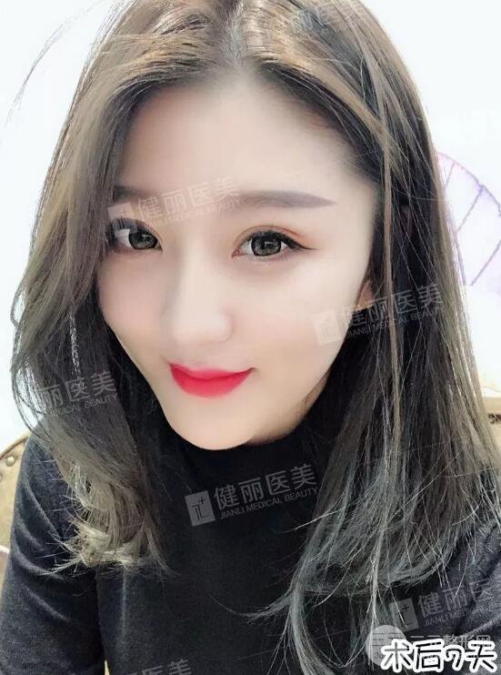 深圳健麗微創(chuàng)去眼袋+眶隔脂肪轉(zhuǎn)移術(shù)前后對(duì)比果圖分享！