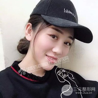 沈陽百嘉麗隆鼻整形前后恢復(fù)圖記錄分享~