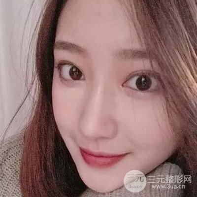 硅膠假體隆鼻案例前后對(duì)比圖分享！顏值變化驚人！