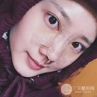 硅膠假體隆鼻案例前后對(duì)比圖分享！顏值變化驚人！
