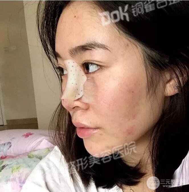 重慶銅雀臺(tái)假體隆鼻前后對(duì)比圖案例分享!