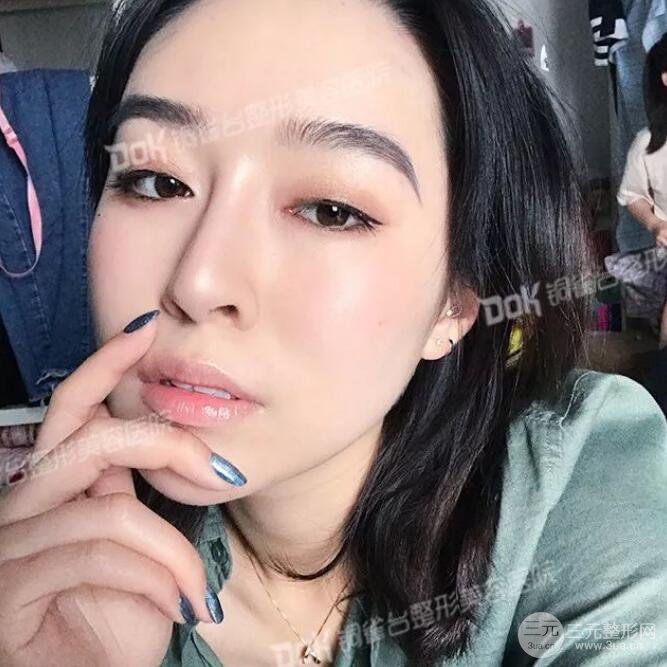 重慶銅雀臺(tái)假體隆鼻前后對(duì)比圖案例分享!