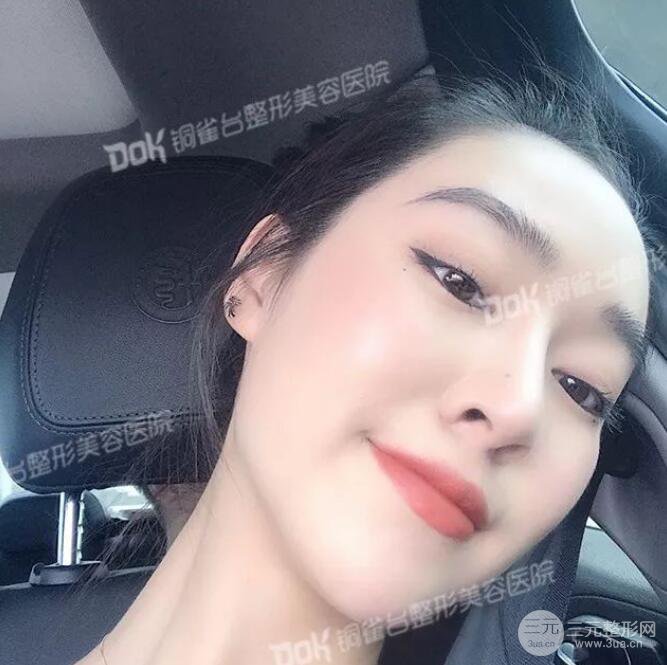 重慶銅雀臺(tái)假體隆鼻前后對(duì)比圖案例分享!