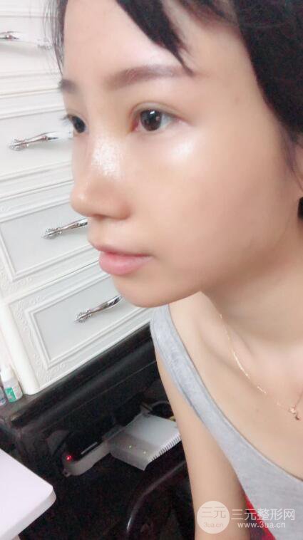 昆明華美美萊楊繼紅肋軟骨隆鼻前后對比圖恢復(fù)手札