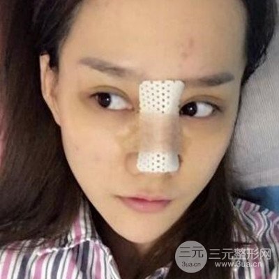 廣州韓妃李光琴隆鼻失敗修復(fù)前后對比圖分享！
