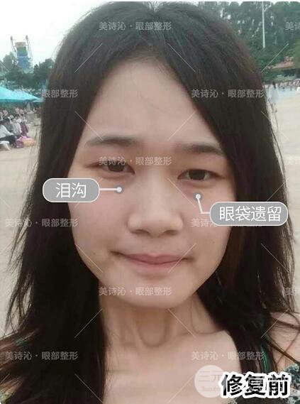 北京詩美沁祛眼袋案例術(shù)后果分享！