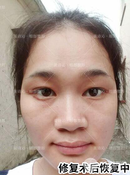 北京詩美沁祛眼袋案例術(shù)后果分享！