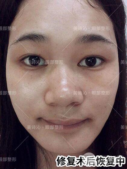 北京詩美沁祛眼袋案例術(shù)后果分享！