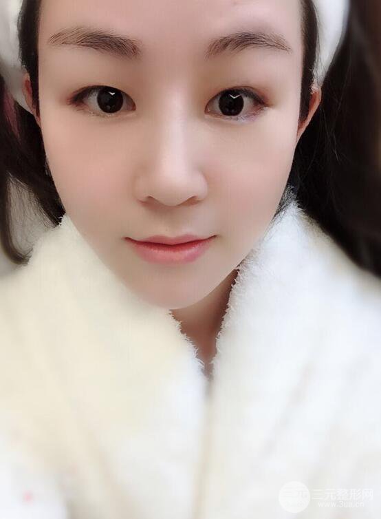 杭州華山連天美高俊明假體隆鼻術(shù)前術(shù)后對(duì)比圖 兩個(gè)月恢復(fù)心情