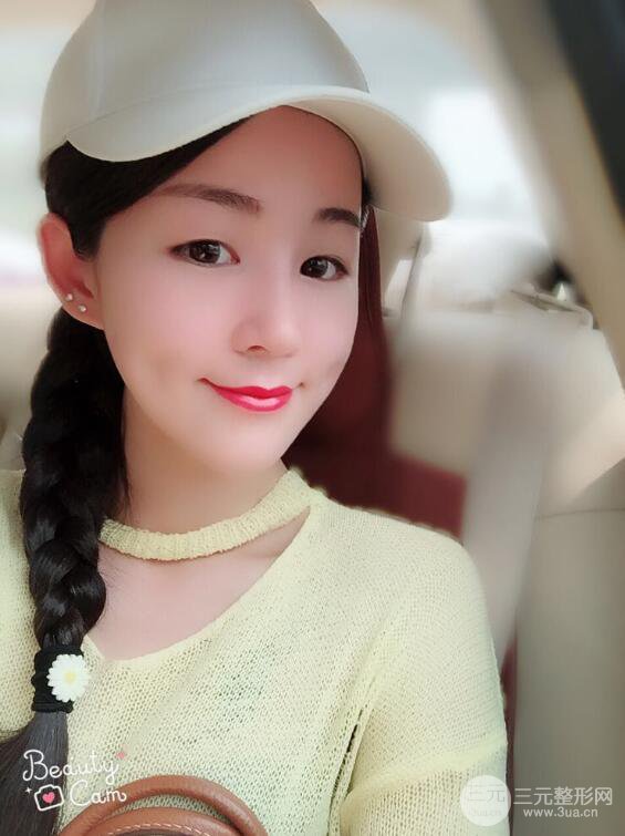 杭州華山連天美高俊明假體隆鼻術(shù)前術(shù)后對(duì)比圖 兩個(gè)月恢復(fù)心情