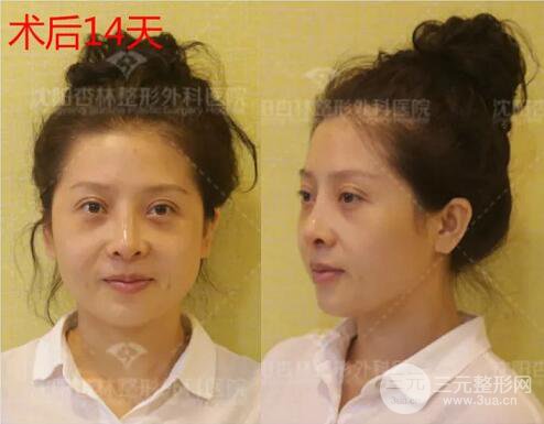 沈陽(yáng)杏林朱石江隆鼻隆鼻整形案例手術(shù)過(guò)程記錄