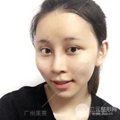 廣州美萊隆鼻整形+自體脂肪填充面部前后對(duì)比圖以及恢復(fù)過程分享