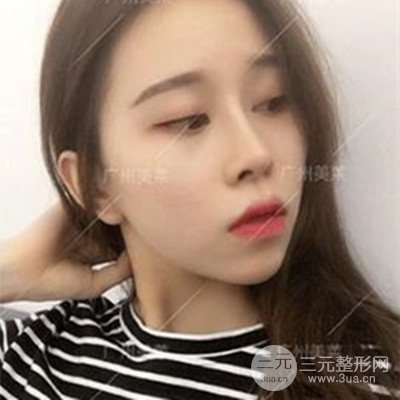 廣州美萊隆鼻整形+自體脂肪填充面部前后對(duì)比圖以及恢復(fù)過程分享