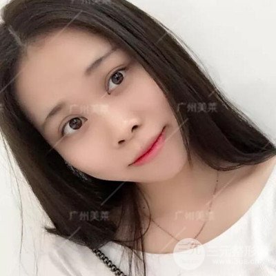 廣州美萊隆鼻整形+自體脂肪填充面部前后對(duì)比圖以及恢復(fù)過程分享