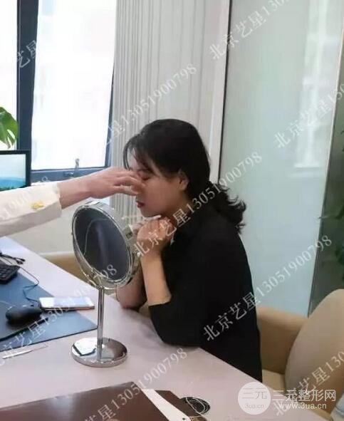 北京藝星仇侃敏微創(chuàng)肋軟骨隆鼻前后對比圖 術(shù)后一個月的恢復(fù)狀況