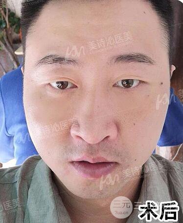 北京詩美沁祛眼袋案例，男士微創(chuàng)祛眼袋果分享！