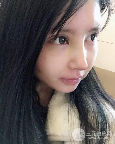 貴陽華美田永成隆鼻整形前后對比圖分享
