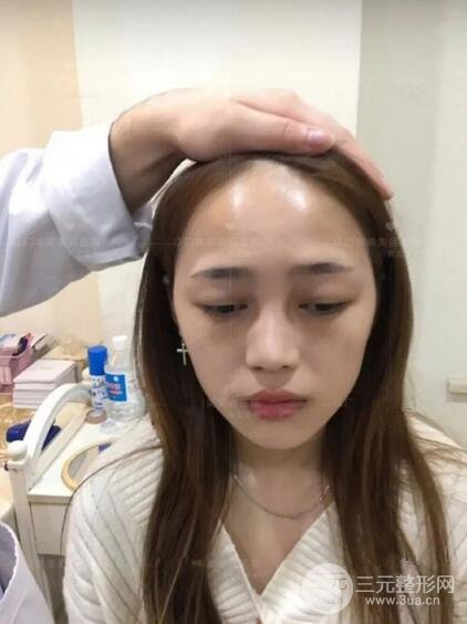 重慶愛思特整形隆鼻案例術(shù)后恢復(fù)果分享！