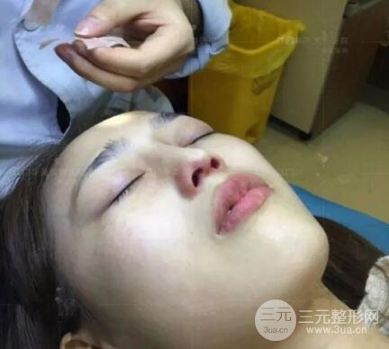 重慶愛思特整形隆鼻案例術(shù)后恢復(fù)果分享！