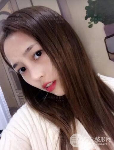 重慶愛思特整形隆鼻案例術(shù)后恢復(fù)果分享！
