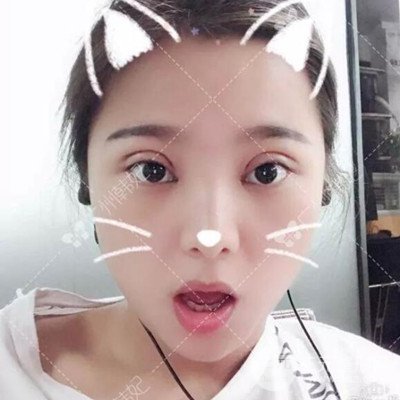 廣州韓妃全切雙眼皮案例日記分享~