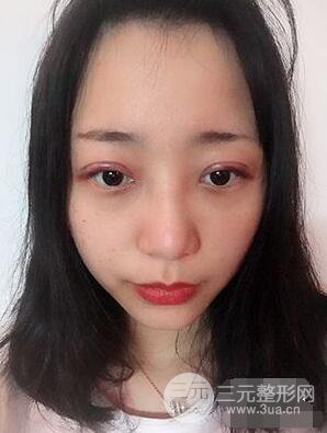 杭州華山連天美高俊明雙眼皮案例前后對(duì)比圖心情分享