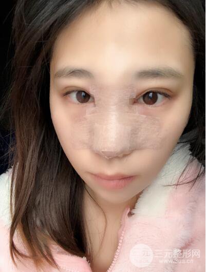 貴陽(yáng)麗都李觀龍隆鼻整形案例對(duì)照?qǐng)D一個(gè)月恢復(fù)過(guò)程分享
