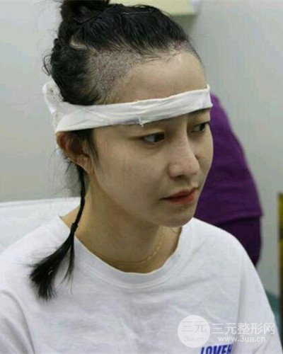 北京雍禾韓巖發(fā)際線種植手術(shù)半年了，分享前后果圖片~