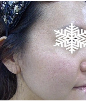 光子嫩膚后皮膚水嫩水嫩的