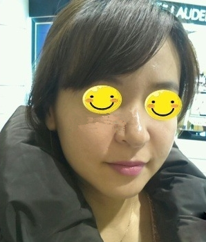 光子嫩膚后皮膚水嫩水嫩的