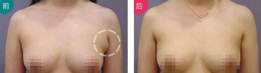 做副乳手術(shù)需要多少錢價(jià)格 副乳切除手術(shù)后果對比照片圖