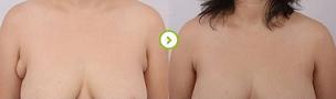做副乳手術(shù)需要多少錢價(jià)格 副乳切除手術(shù)后果對比照片圖