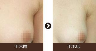 做副乳手術(shù)需要多少錢價(jià)格 副乳切除手術(shù)后果對比照片圖