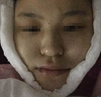 整成瓜子臉需要多少錢價(jià)格 整形瓜子臉需要多少錢價(jià)格 整個(gè)瓜子臉需要多少錢價(jià)格