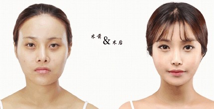 酒窩整形有沒有半永.久的 酒窩整形有哪些方法