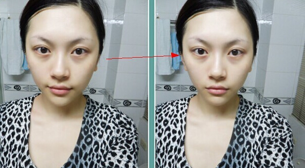 打完B****咬肌突然鼓起一塊什么原因啊