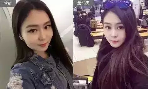 注射注射瘦臉使用失敗的女星案例
