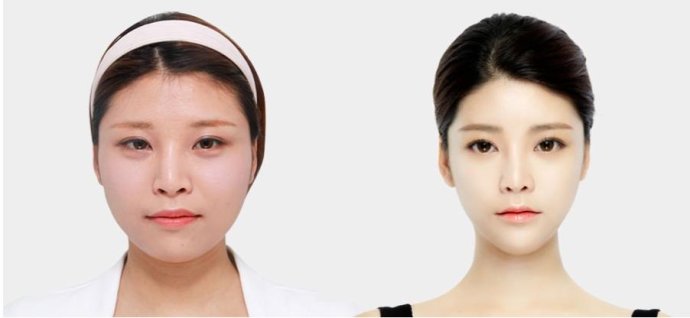 注射注射瘦臉使用失敗的女星案例