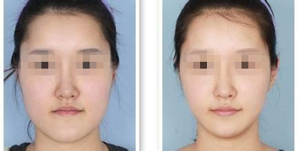 注射注射瘦臉使用失敗的女星案例