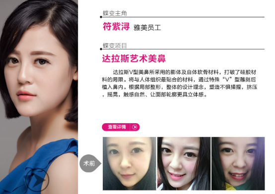 進口膨體,進口豐胸