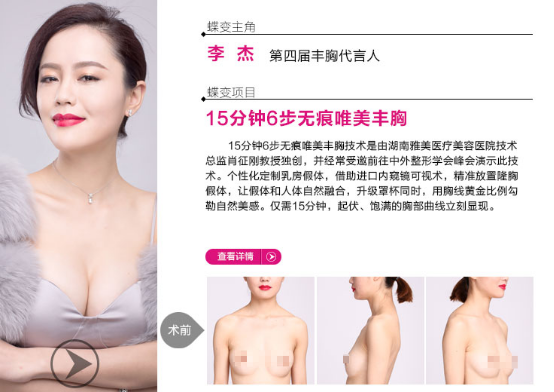 進口膨體,進口豐胸